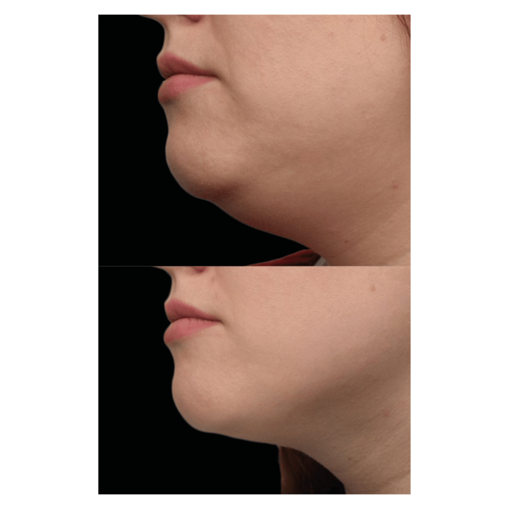 Emface Submentum treatement before and after.