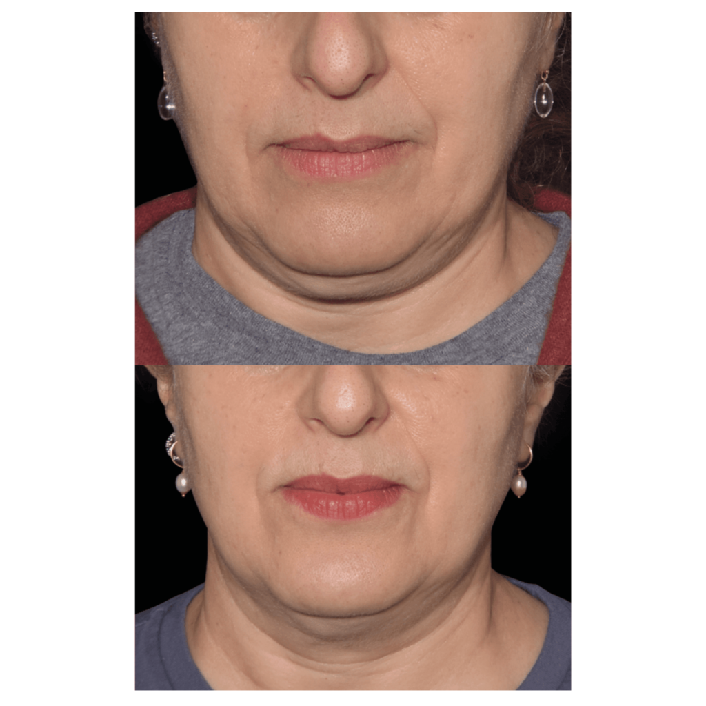 Emface Submentum before and after.